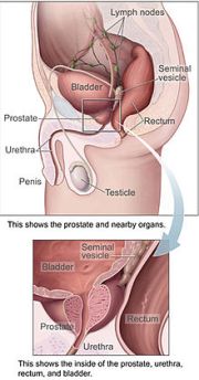 prostate-cancer